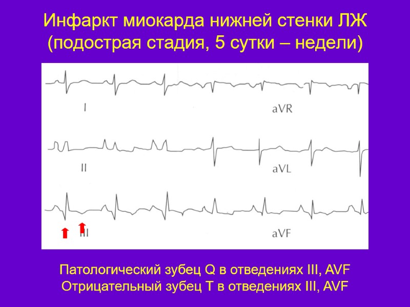 Инфаркт миокарда нижней стенки ЛЖ (подострая стадия, 5 сутки – недели) Патологический зубец Q
